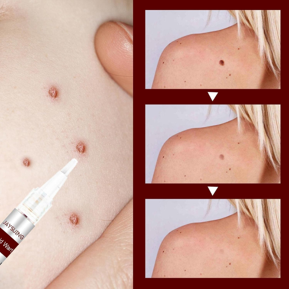 Buy 1 Get 1 Free OFFER🔥Liquid Wart and Skin Tag Removal